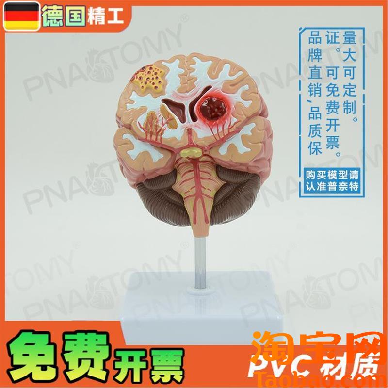 德国】人脑病理解剖模型脑geng大G脑疾病血管堵塞标本教学脑科神