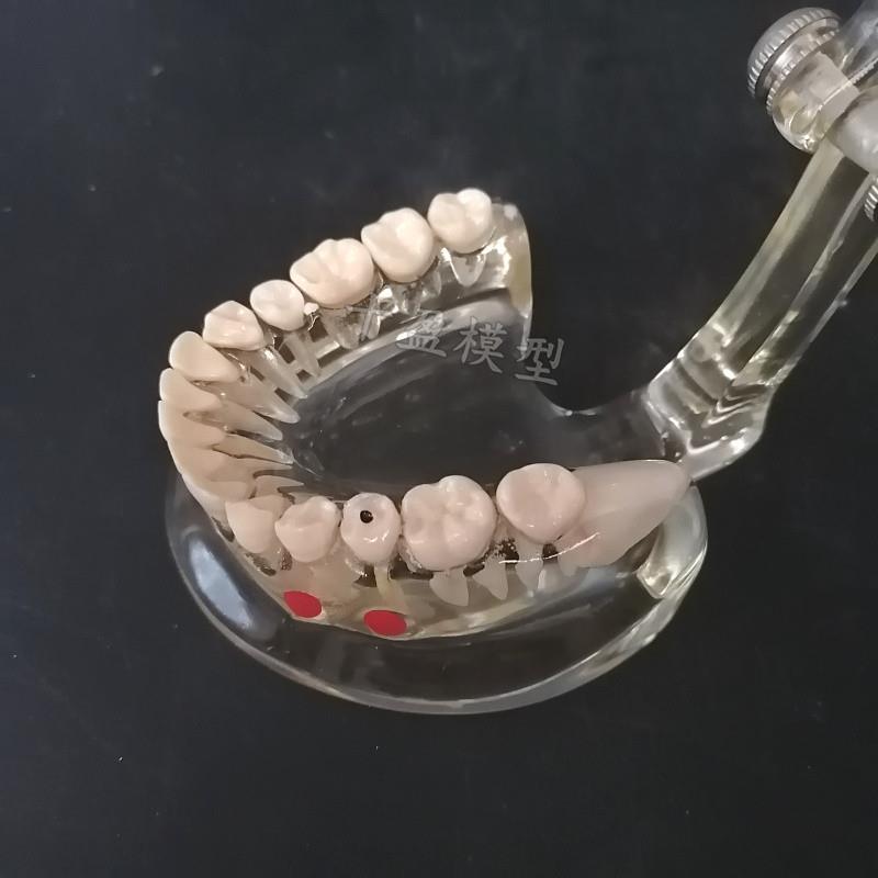 原装适用牙科牙齿模型成人病理半侧可拔牙模型医患沟通口腔教学教