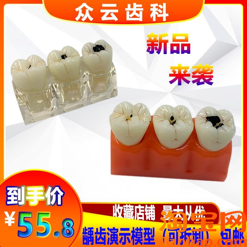 牙科模型四倍龋齿演m变模型蛀牙演示医患沟通龋齿发展病理分解模