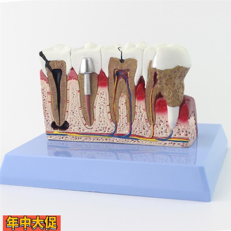 ENOVO颐诺牙齿模型口腔牙齿科种植模型口腔病理模型口腔医院医患