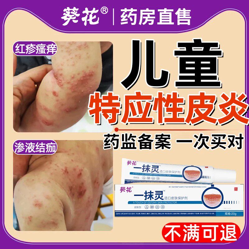 儿童特应性皮炎止痒去身体乳皮肤瘙痒抑菌特异性宝宝湿疹软膏