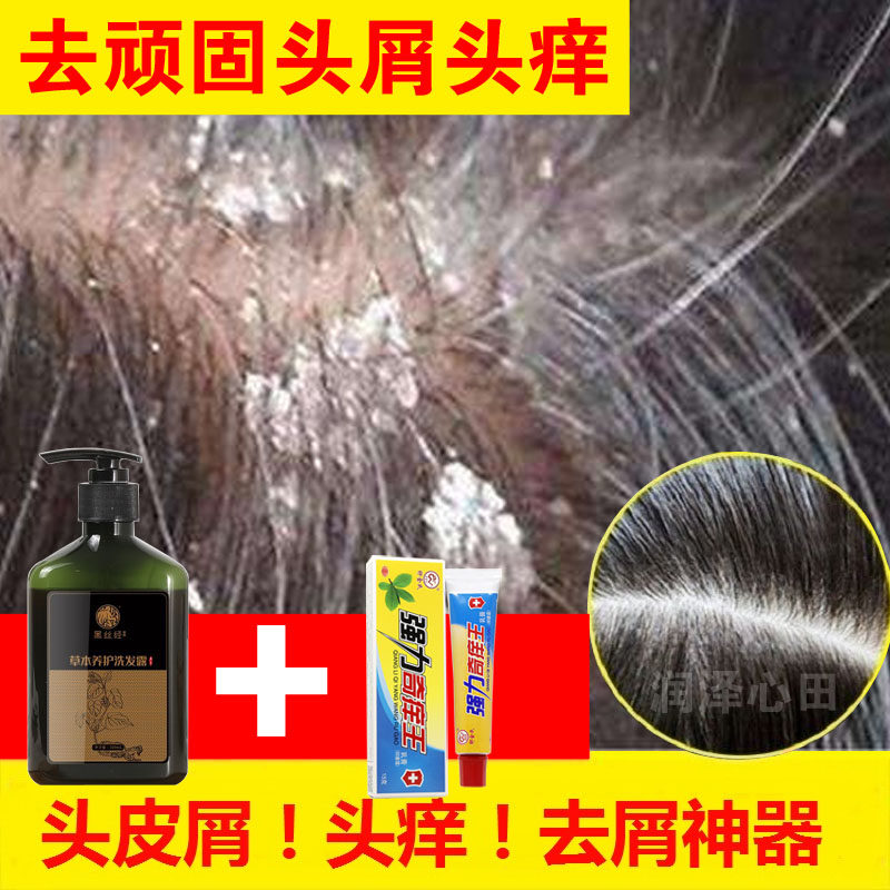 严重头屑头痒洗发水同康锦域发丝皮屑净屑净油洗发剂错洗头屑屑清