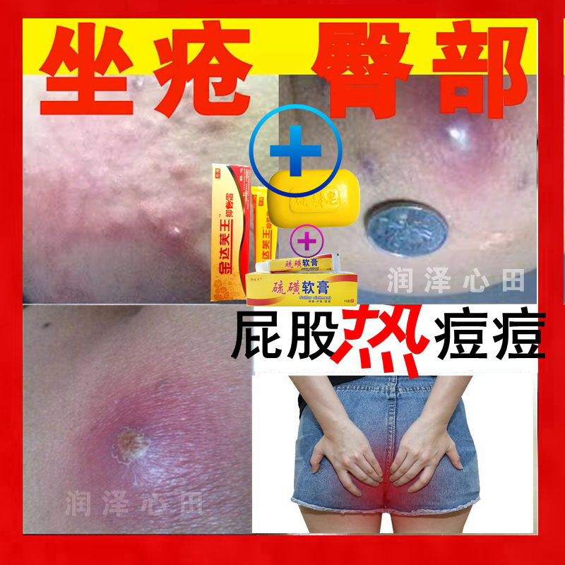 屁股长豆了座板仓疮膏屁股上解毒久长热豆疖子浓包水