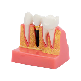牙齿模型口腔牙科模具标准假牙可拆卸医患沟通教学练习种植摆件