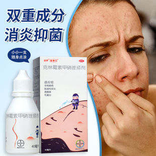 克林霉素甲硝唑搽剂毛囊炎去痘痘的药膏治酒糟鼻红鼻子专用药XJ