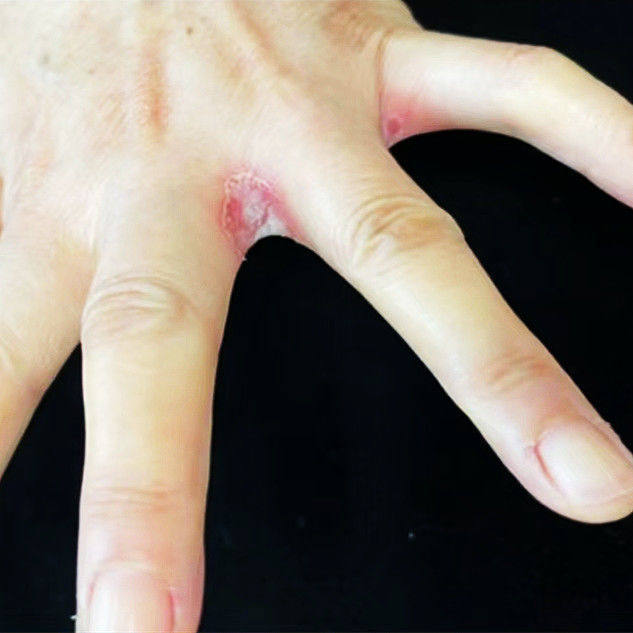 手指缝溃烂烂手丫药溃烂手指手烂药膏手指溃烂发红脱皮瘙痒手丫烂