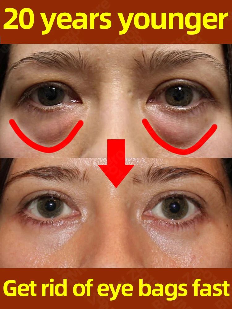 Creme dos círculos escuros e saco do olho, anti sacos nos o