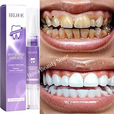 Magical Teeth Whitening Pen Effectively Removes Dental Plaqu