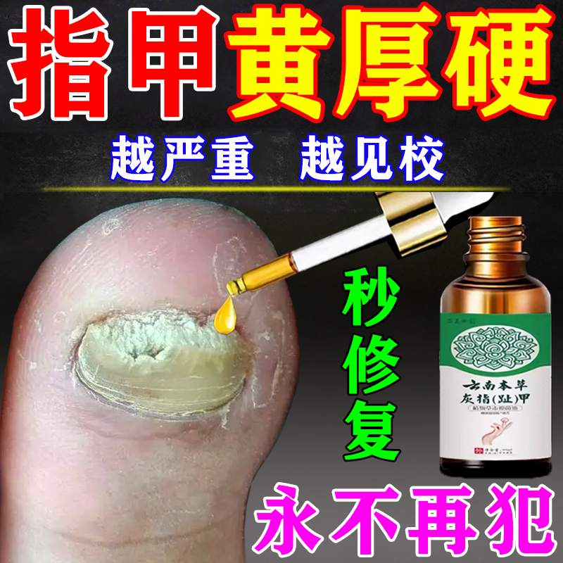 脚指甲发黄变厚增厚变硬真菌性白甲空甲床分离修复灰甲治疗专用药-封面