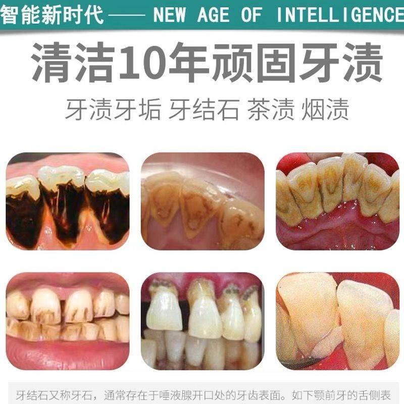 洗牙齿污垢除牙石牙垢牙结石清除神器清理牙结石去除