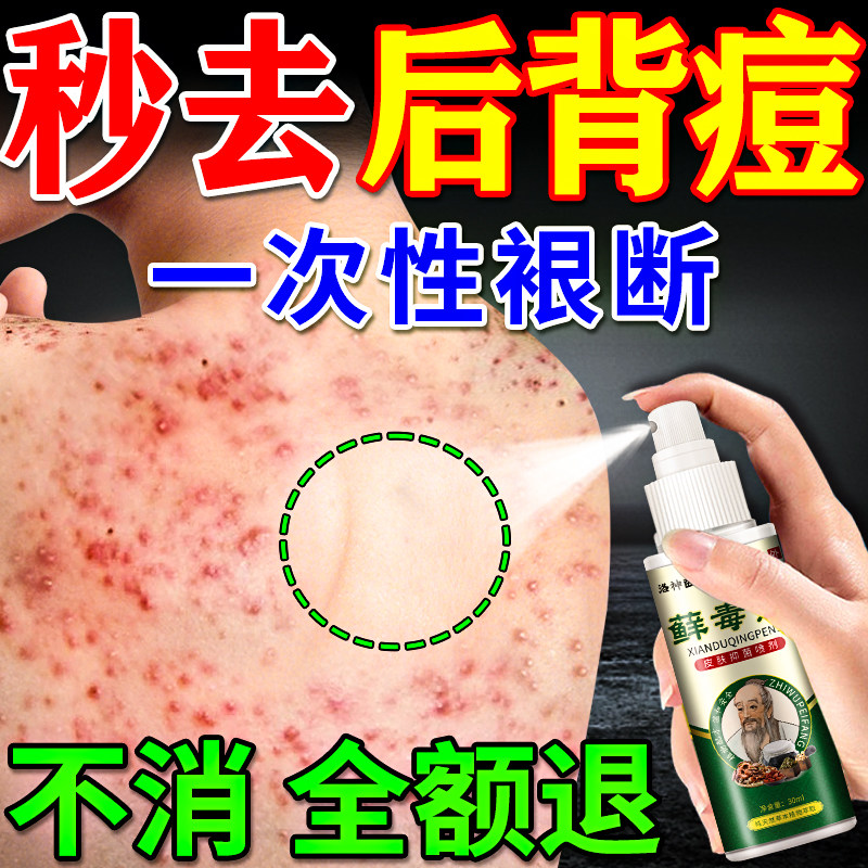 后背祛痘喷雾去除前胸背上痘痘螨虫毛囊炎疙瘩痤疮止痒效特喷剂药