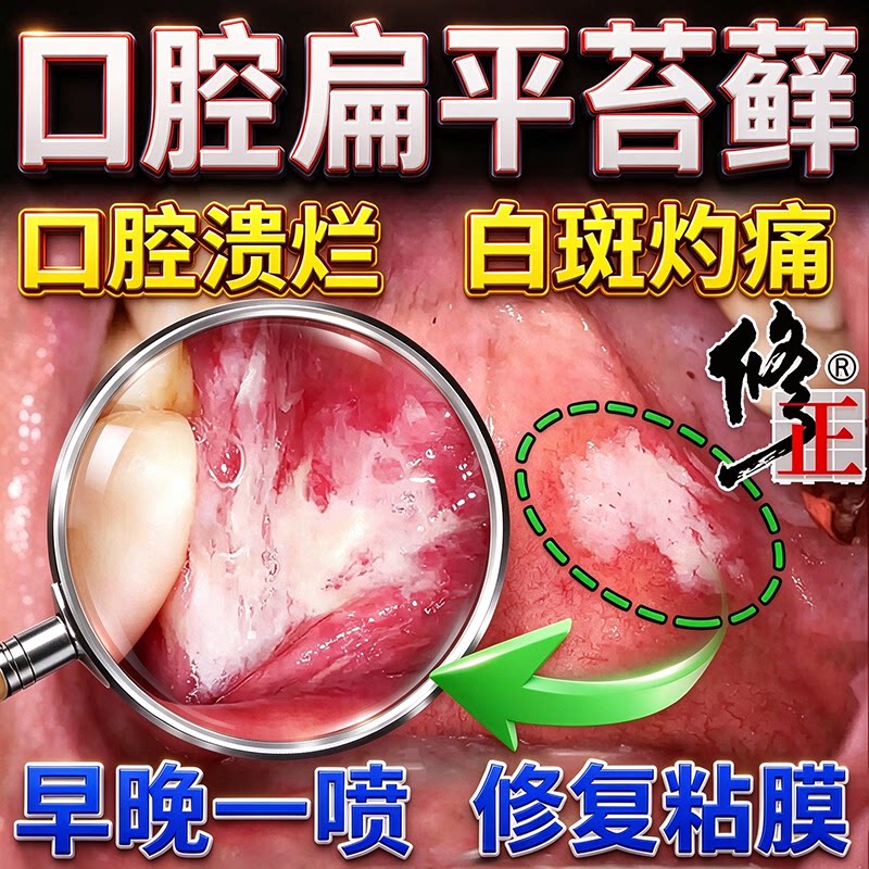 口腔溃疡专用口腔扁平苔藓喷剂口腔粘膜白斑修护舌头疼痛溃烂喷雾