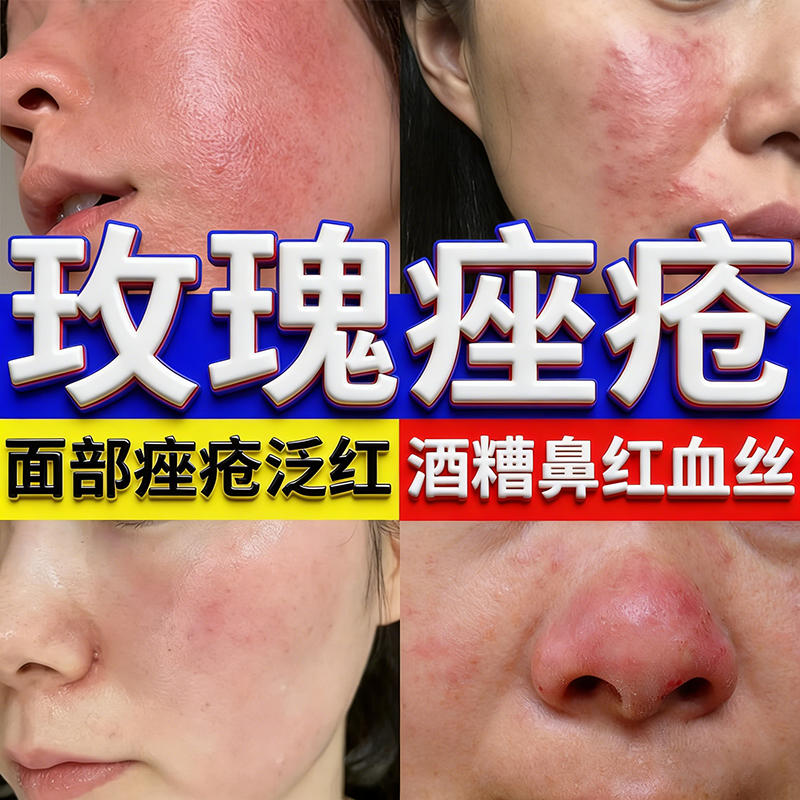 痤疮专用膏玫瑰痤疮粉刺硬消炎青少年保湿补水淡斑学生祛痘印膏药