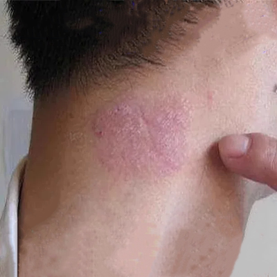 顽皮藓治疗牛皮癣银屑病皮肤去湿疹止瘙痒根神经性皮炎专外用药膏