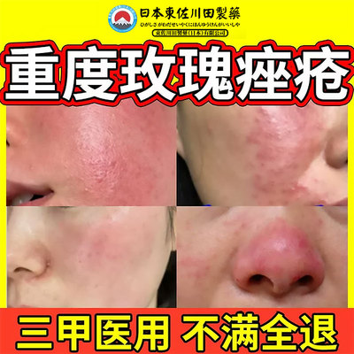 去暗疮闭口粉刺玫瑰痤疮特效痘痘伊维菌素炎修复消祛痘印药膏重度