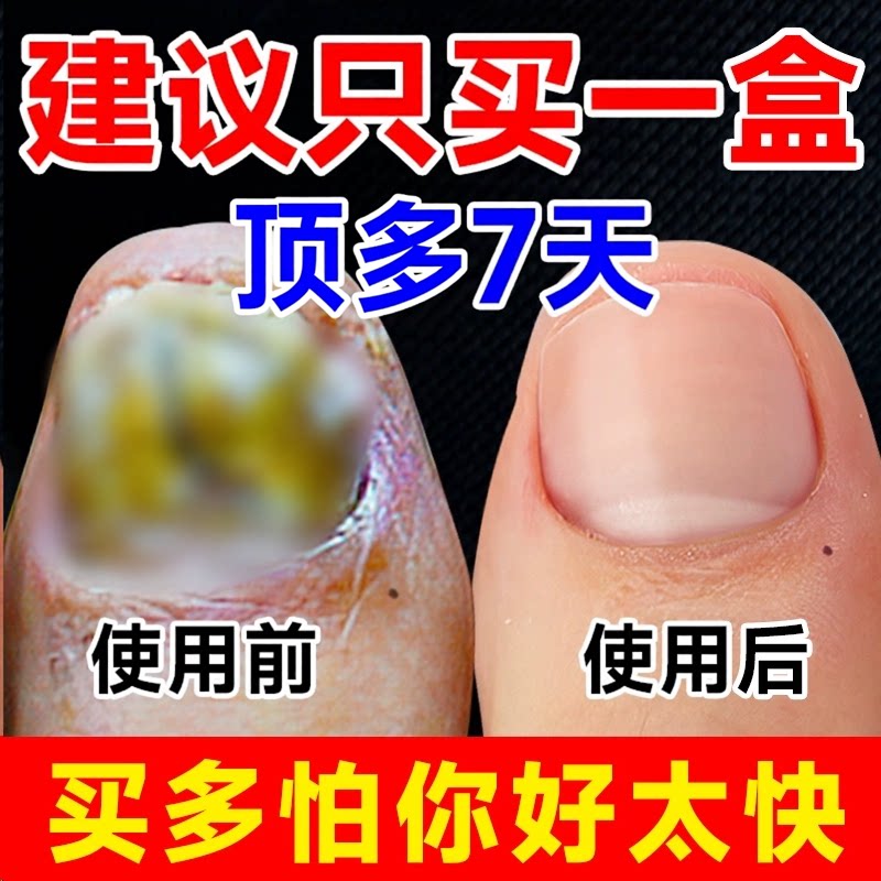 阿莫罗灰指甲芬搽剂修复液脱甲膏去除增厚药水正品官方旗舰店