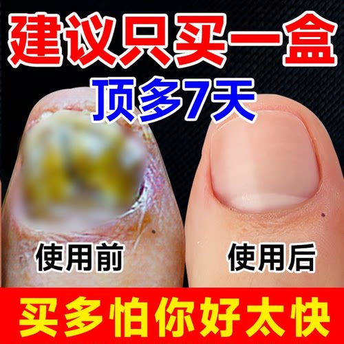 阿莫罗灰指甲芬搽剂修复液脱甲膏去除增厚药水正品官方旗舰店