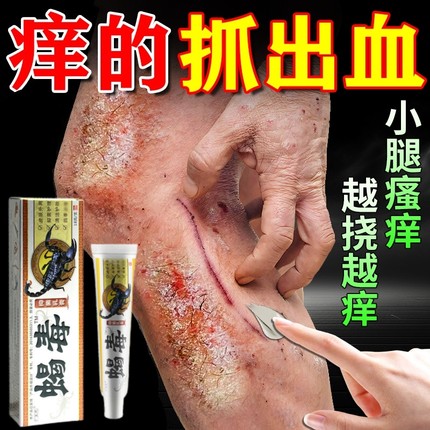 春夏腿痒天气热小腿皮肤瘙痒过敏湿疹换季腿上起红点止痒杀菌药膏