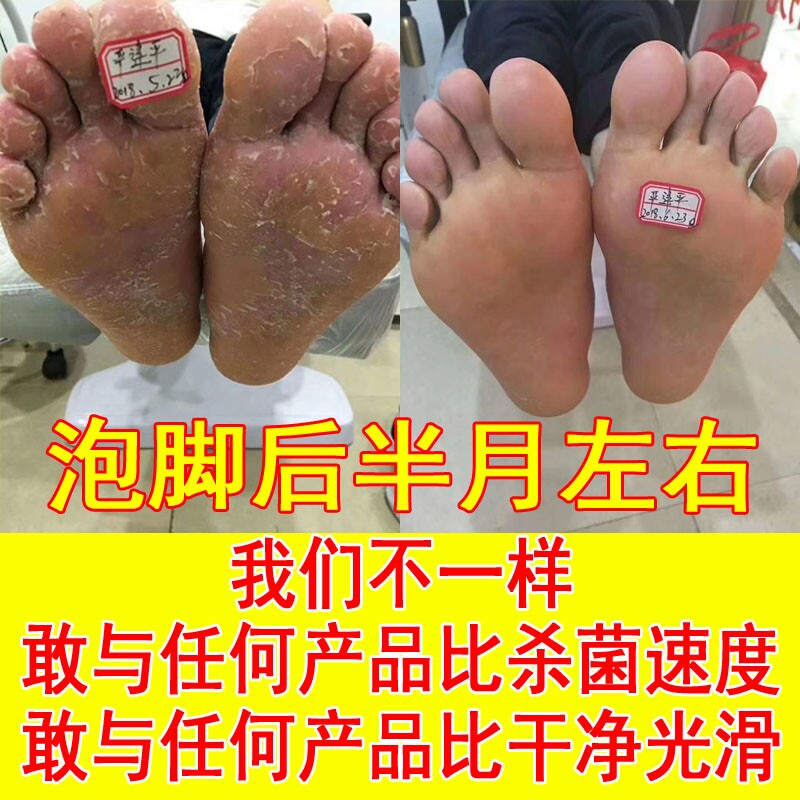脚痒烂脚丫药脱皮气糜烂脚趾缝烂皮肤消毒护理（消）