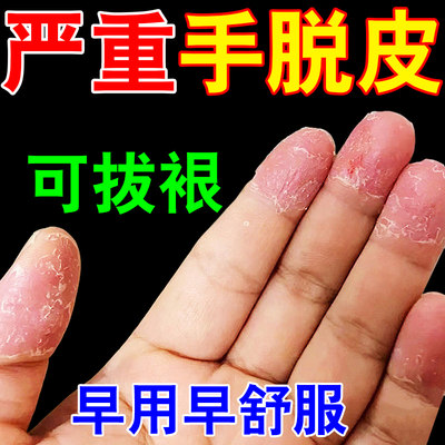 手脱皮药膏严重脱皮专用真菌感染季节性汗泡泡疹起水泡手上起皮干