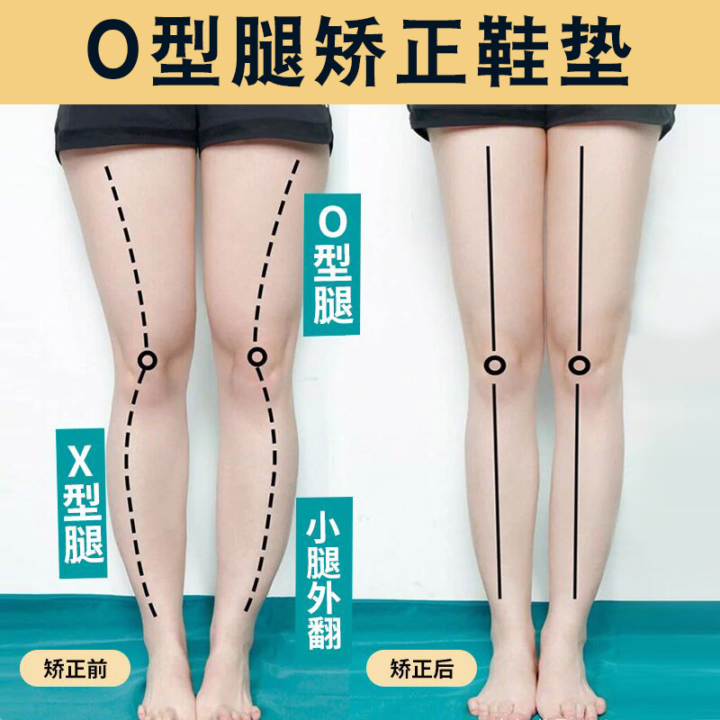 o型腿矫正鞋垫小腿外翻xo型腿x型罗圈腿矫正器纠正腿型直腿神器