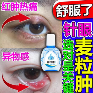 麦粒肿针眼滴眼液眼睑板腺眼睛红肿疼痛有硬结黄色脓点模糊眼药水