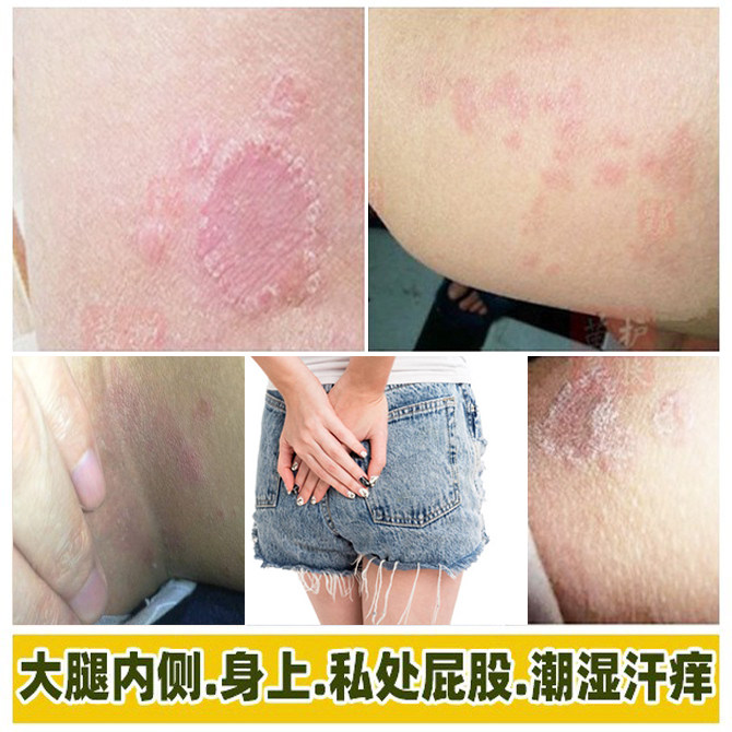苗锐阴痒王抑菌乳膏私处异味痒