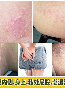 阴痒王抑菌乳膏大腿内侧潮湿私处阴囊屁股上长痘痘痒起热疙瘩痒膏