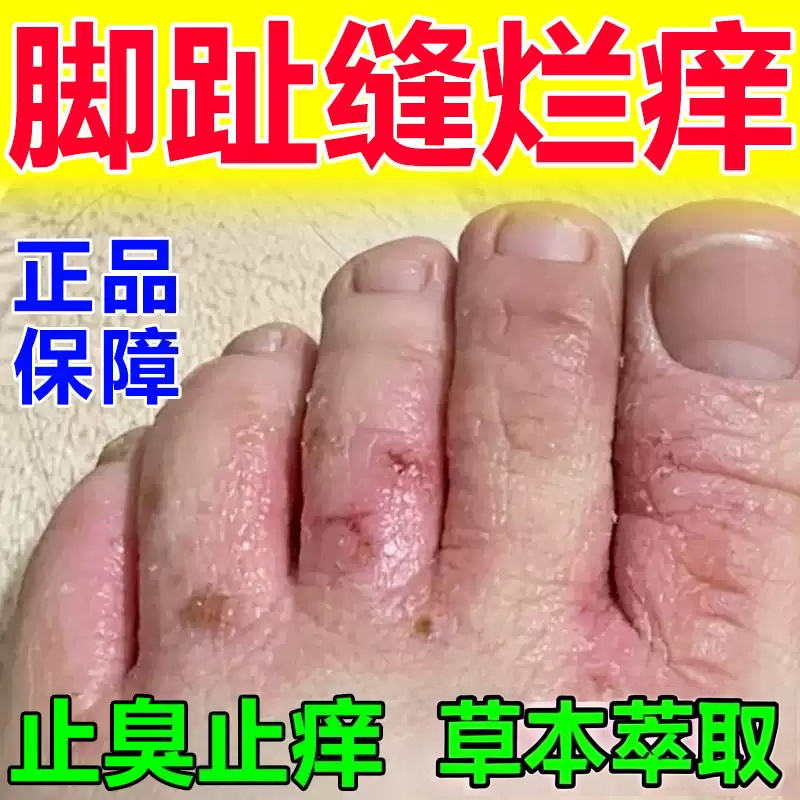 脚气烂脚丫药脱皮糜烂脚趾缝烂痒止脚丫子开裂一次净专用止痒草膏