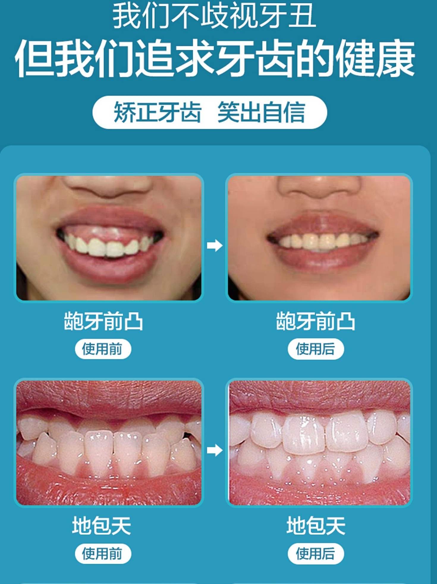 4d升级款 牙套 全套三个阶段 睡觉时牙整齐了 透明 通用 矫正牙齿