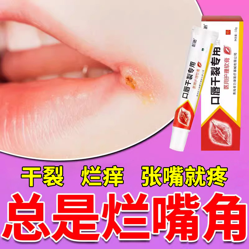 唇膏口角炎药膏儿童嘴巴上火起泡烂嘴角开裂干燥起皮痒润唇修护膏