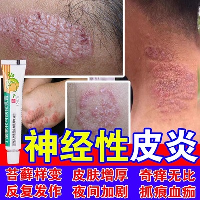 【尤伯松】丁酸氢化可的松乳膏0.1%*10g*1支/盒
