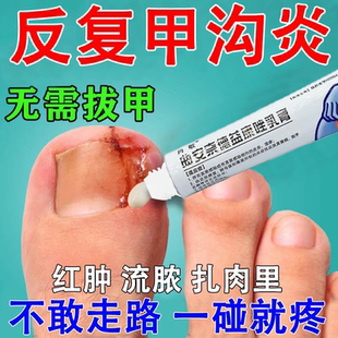 甲沟炎治疗专用药指甲往肉里长脚勾炎外敷药膏消炎消肿去息肉芽WM