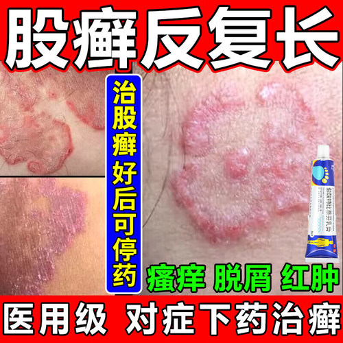 【嘉效】盐酸特比萘芬乳膏1%*25g*1支/盒股癣皮肤癣痒专用药大腿内侧瘙痒体癣牛皮癣