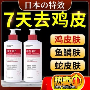 鸡皮肤疙瘩毛囊角质毛周症病干燥起皮鱼鳞蛇皮膏身体乳去除神器