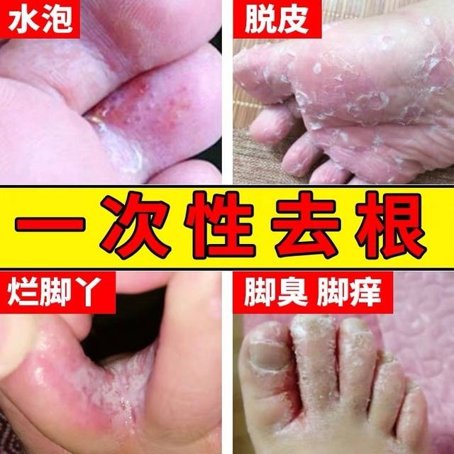喷剂止痒脱皮抑菌水泡型脚臭粉脚痒膏泡脚水烂脚丫