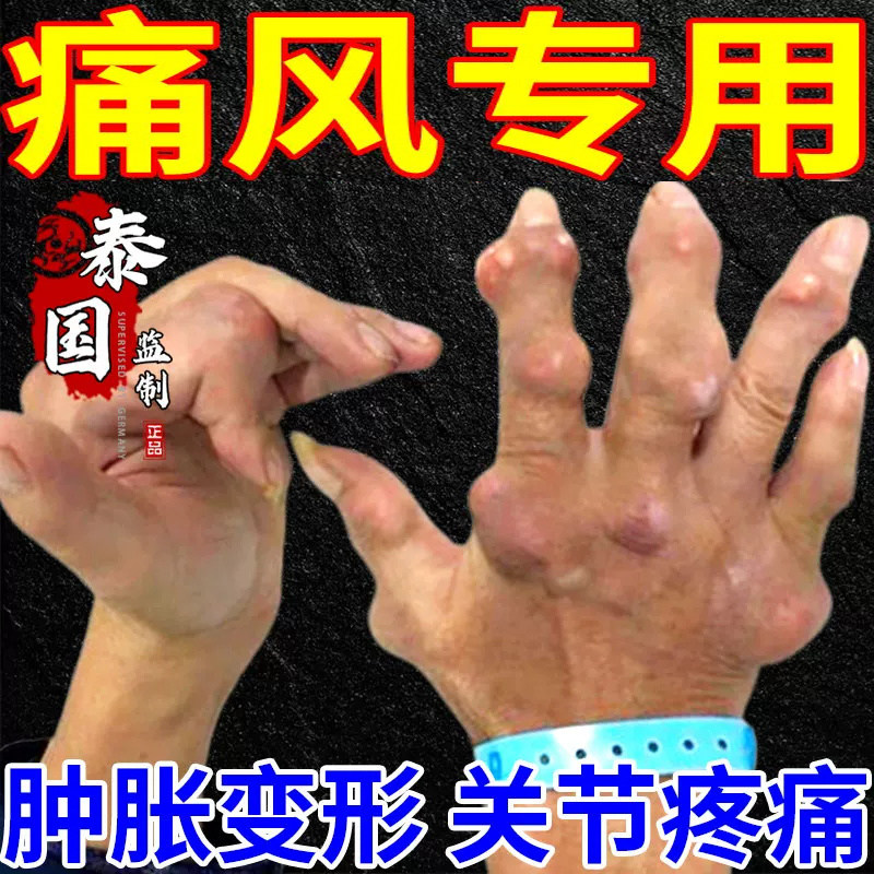 复方独活吲哚美辛胶囊风湿性关节炎帝人痛风缓解炎性疼痛消肿止痛