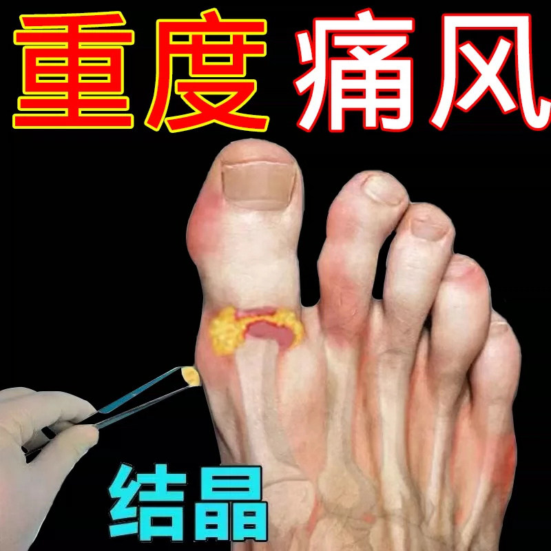 迪根双氯芬酸钠缓释片手指骨关节炎专用药关节炎痛风特效药新版