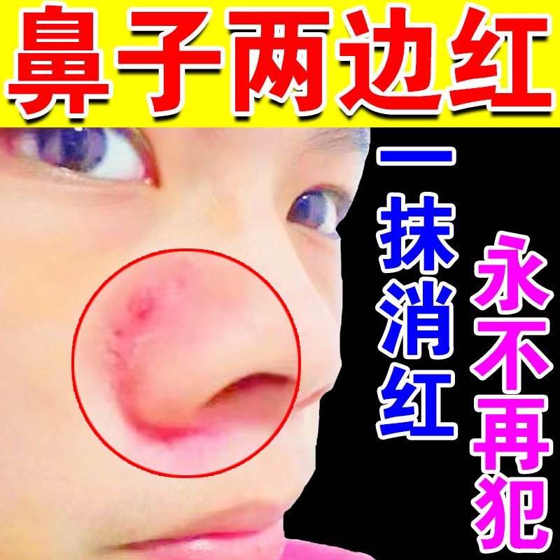 鼻翼两侧泛红毛孔粗大去螨虫治酒糟鼻红鼻子去鼻子红肿修复专用药