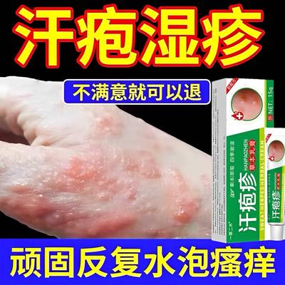 手上起小水泡汗状疱止痒汉状珍真菌感染云南本草专用药膏软膏