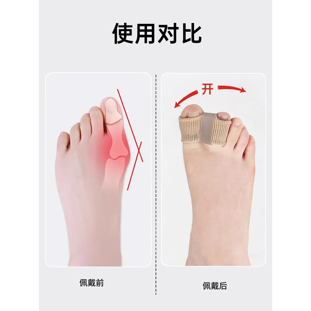 脚拇趾硅胶矫正器拇指外翻可以穿鞋硅胶脚趾环分离器透气脚拇指套