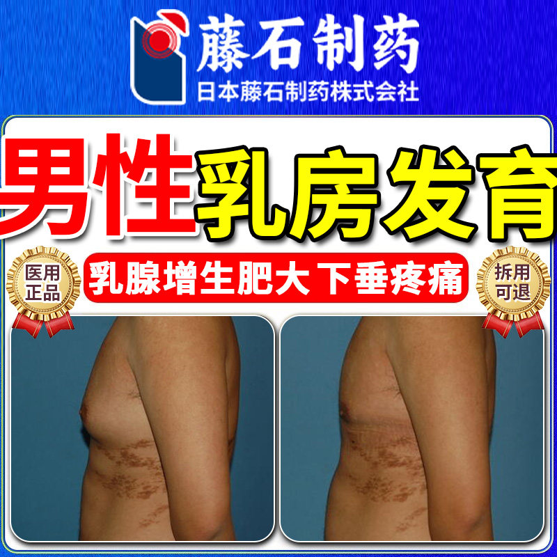 男性乳腺发育症增生乳房肥大胀痛结节散结贴男士胸部雌化胸SQ