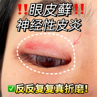 眼皮癣神经性皮炎眼睛周围眼角痒干燥起皮掉屑红肿搭专用膏药贴YU