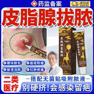粉瘤皮脂腺囊肿拔毒皮下脂肪硬块疙瘩火疖子可搭专用拔脓膏药贴YY
