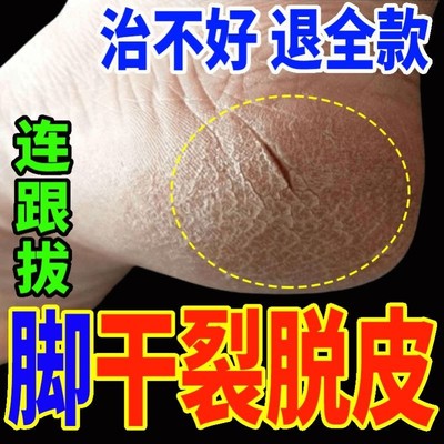 治脚裂脚后跟足跟干裂开裂皲裂真