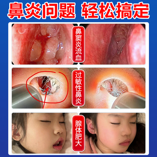 修正远红外鼻敏贴打喷嚏流鼻涕过敏性鼻炎鼻塞急慢性鼻窦炎MM3