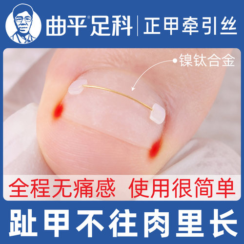 →【曲平医生】←甲沟嵌甲矫正丝