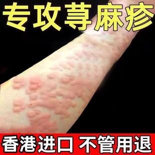 寻荨麻疹过敏止痒慢急性风团皮肤药瘙痒胆碱划痕提高免疫力膏