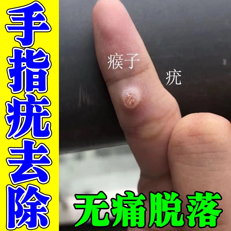 疣瘊肉粒一抹无忧治猴肉刺药膏去除小肉疙瘩跖疣鼓包尤肤平尤立净