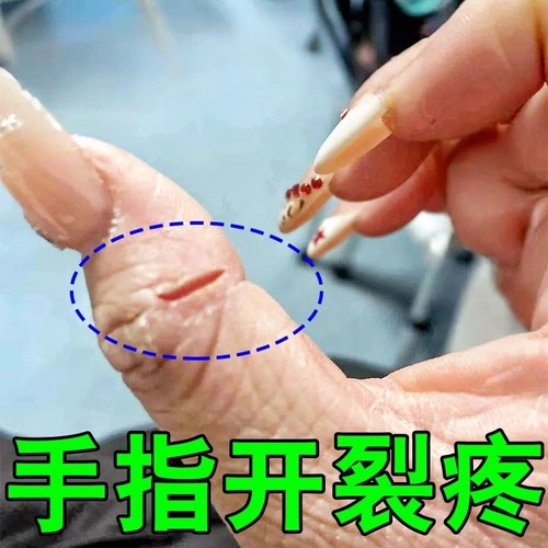 治手裂的药膏手指头干裂真菌感染防皲裂药膏开裂口干燥粗糙护手霜
